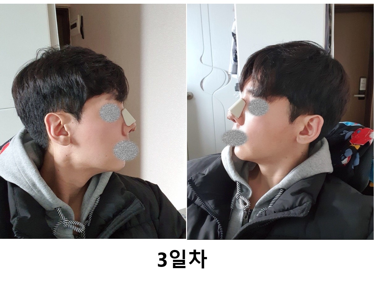 코 수술 3일차