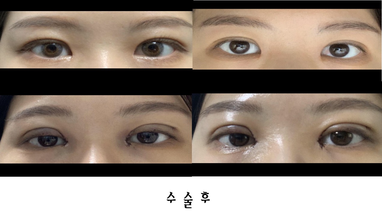 쌍꺼풀 눈매교정 앞트임 후기!