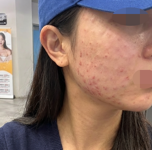 여름 되니 피부톤까지 어두워져서 리쥬란 받고 왔어요~