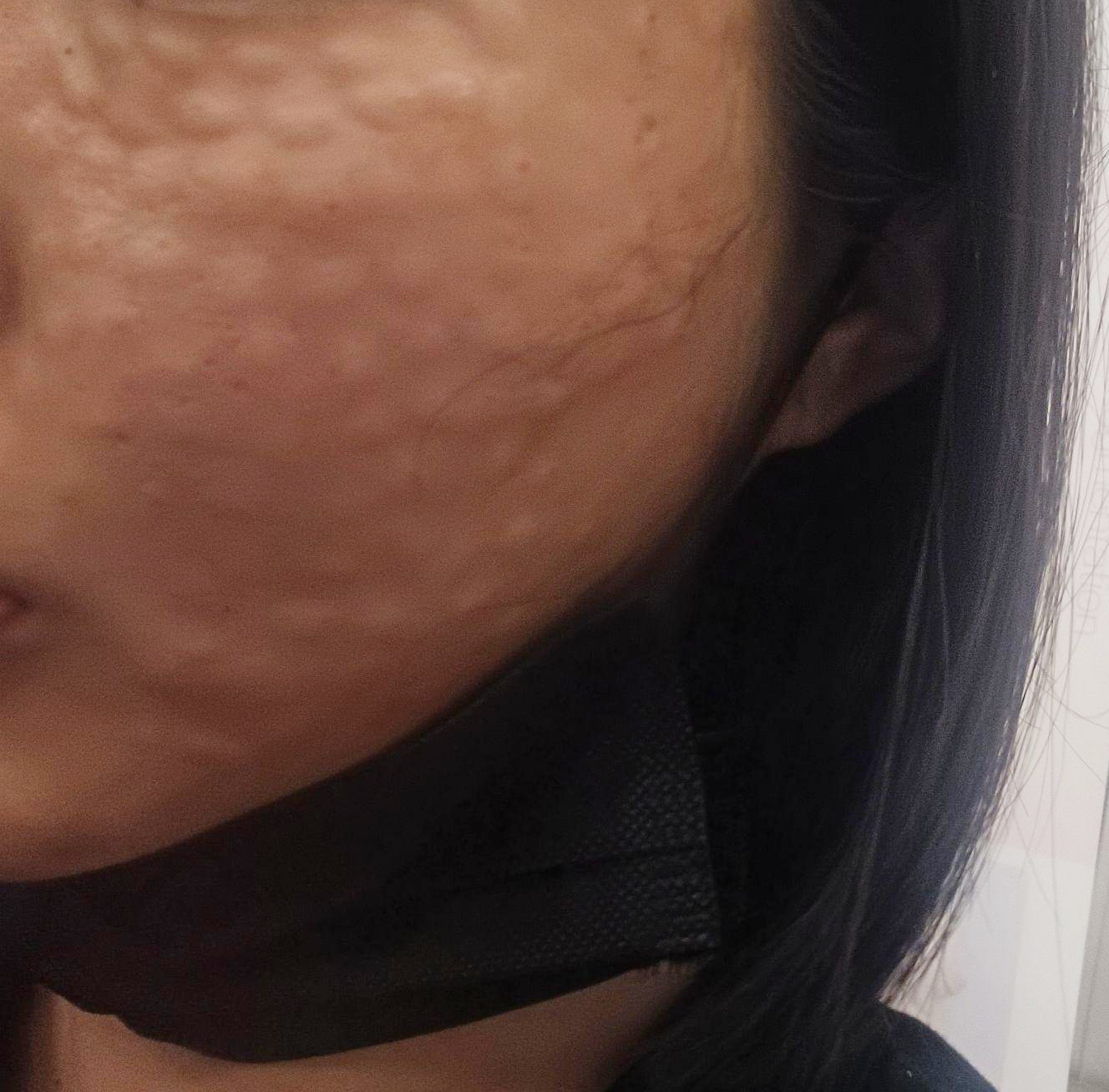 엠보도 만족, 병원 친절함도 완전 만족이라 재방문 확정이에요~ㅎㅎ