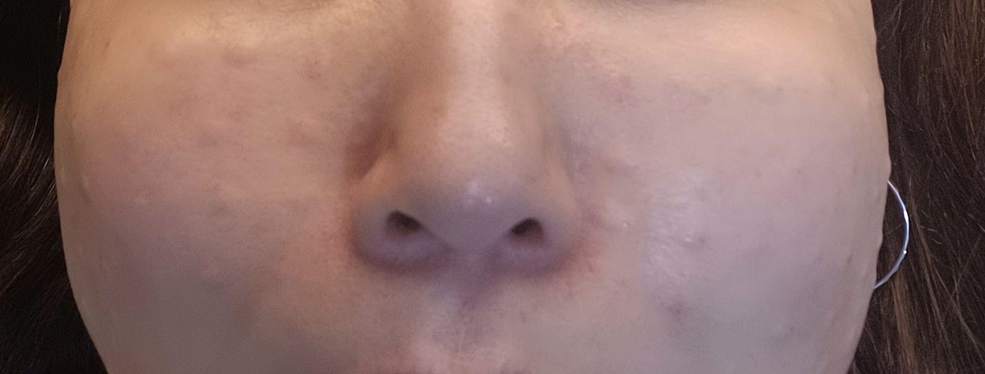건조한 피부 고민이라면 리쥬란 강추드려요!!