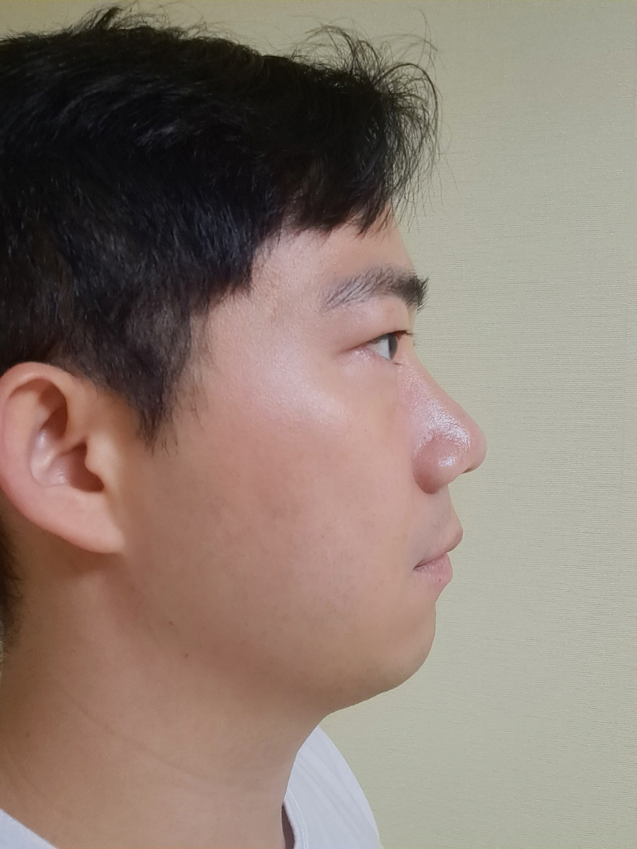 너무 자연스럽게 코가 얼굴에 자리를 잡아서 이젠 정말 원래 제 코처럼 느껴집니다.