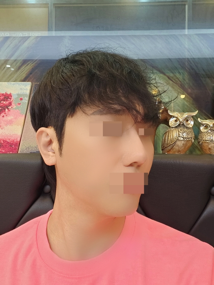 마음에 안들던 코끝모양을 교정했어요