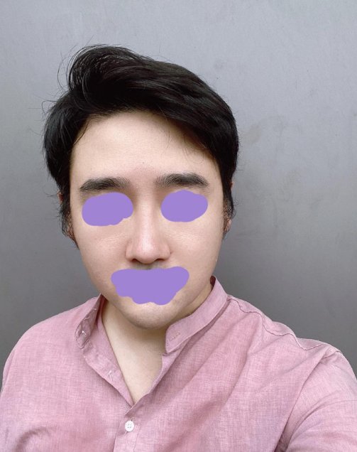 코수술 3개월차입니다