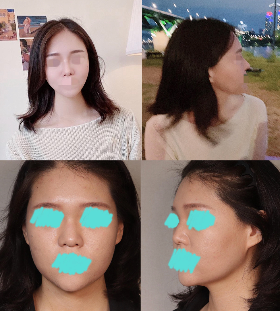 황원장님께 코수술 받은지 벌써 3개월이에욧!