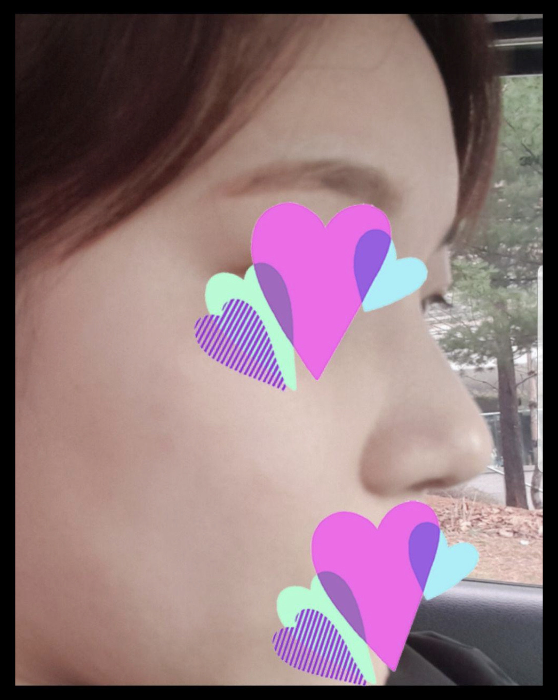 수술 두달차 후기입니다!