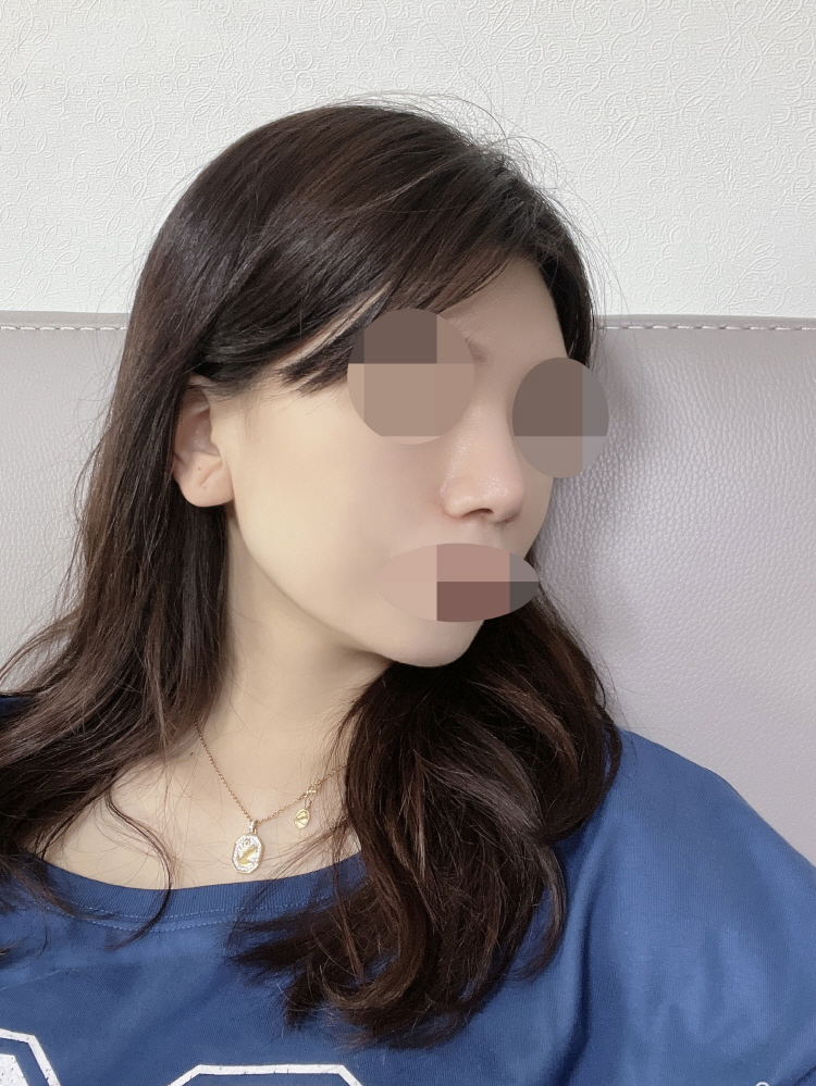 콧볼, 코끝 컴플렉스 한번에 해결 했어요