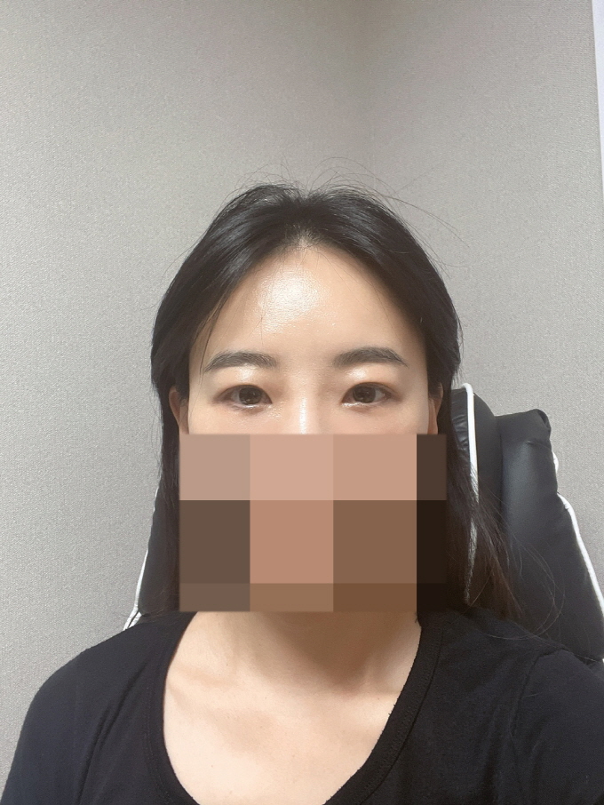 하는 김에 고민이었던 부분도 같이 했는데 만족해요~ 일상생활도 금방 가능했어요~
