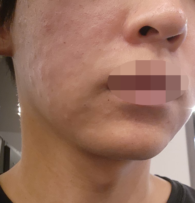 예방 목적으로 수면 리쥬란, 통증 없이 편하게 받았어요!