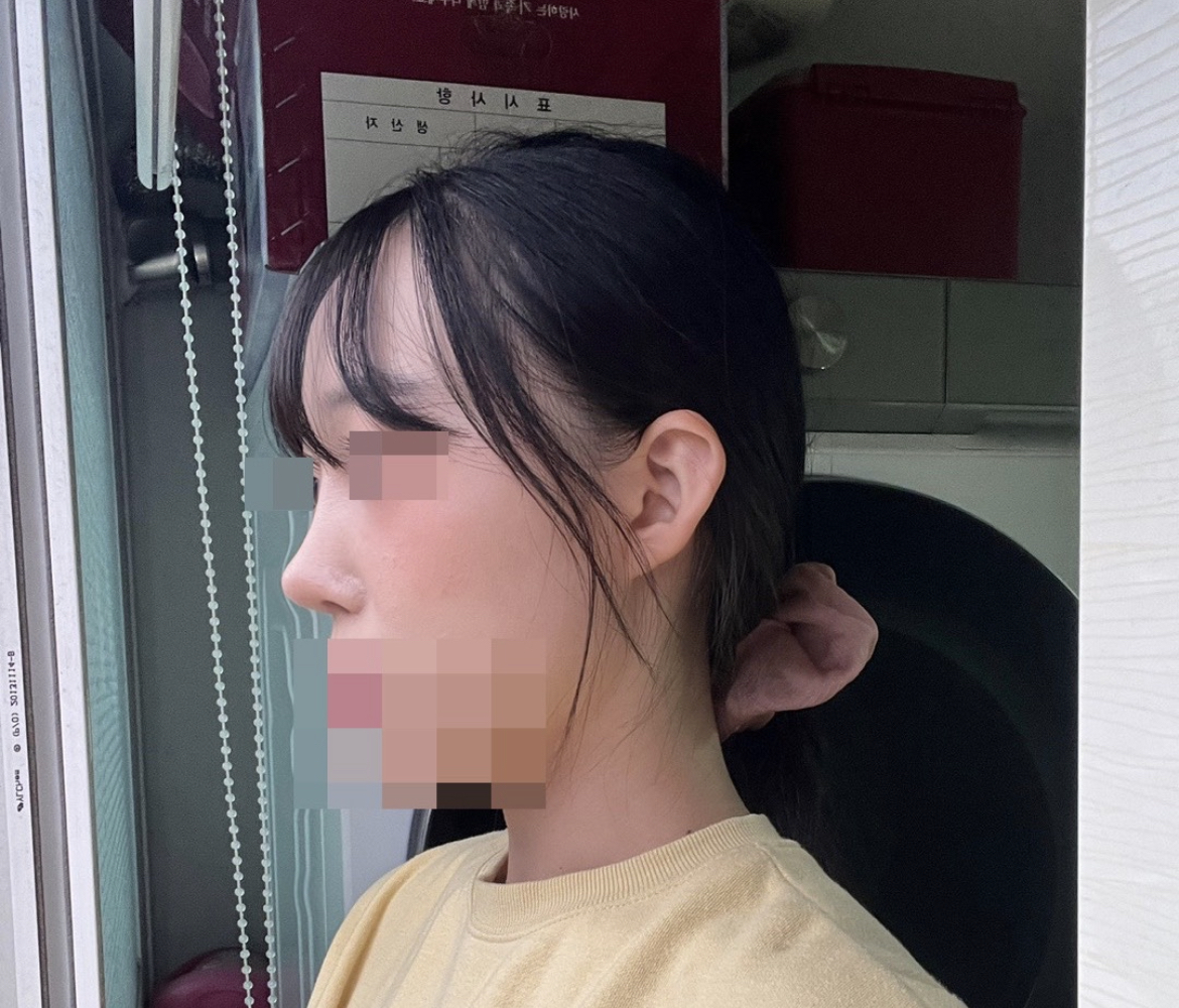 제 감을 믿고 서울아이성형외과에 코를 맡겻습니다 ! 결과는 너무 만족해요 ㅎㅎ