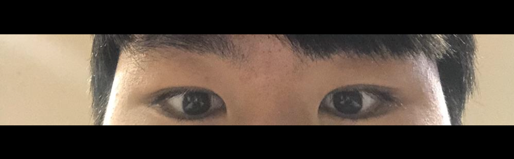 남자 눈매교정 쌍꺼풀수술