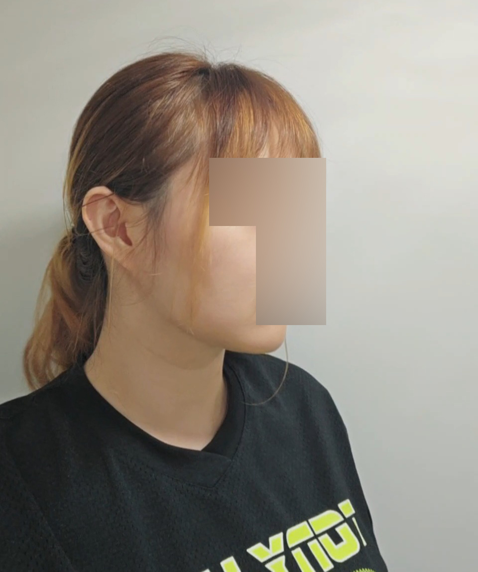 이중턱·턱라인 지방흡입 2달차! 얼굴선이 달라졌어요 ^_^