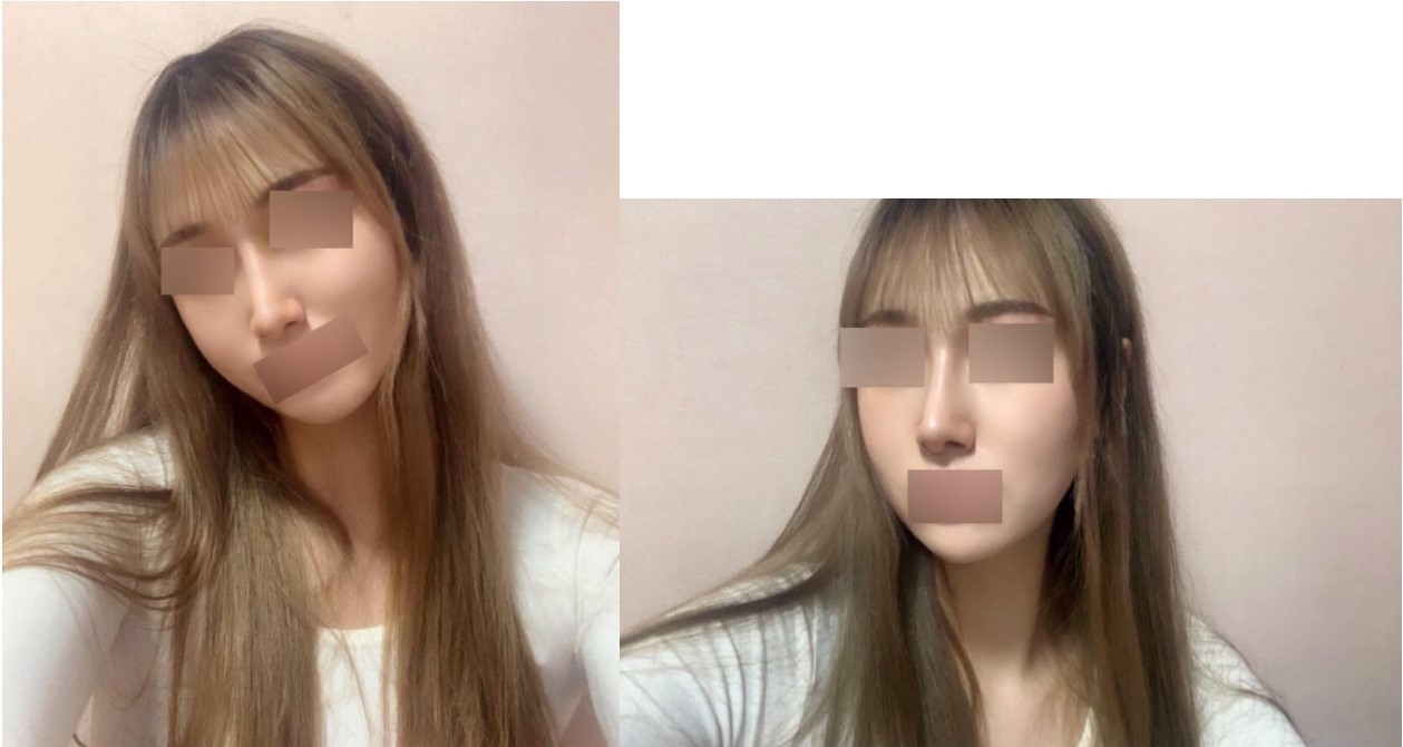 코 수술한지 한달 차입니다앙