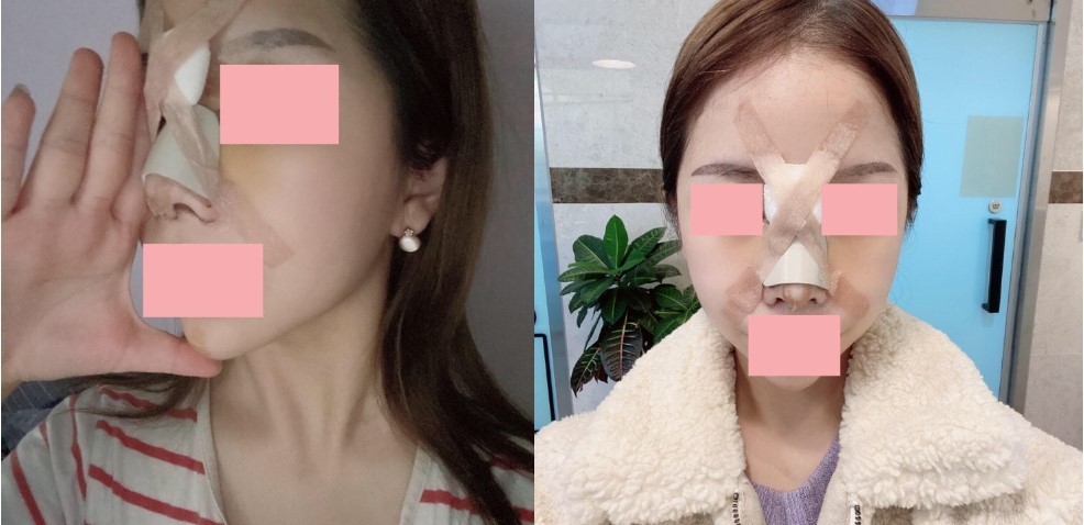 코수술
