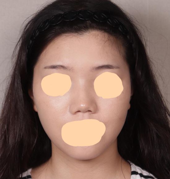 7월 수술후기 이제야 남기네영