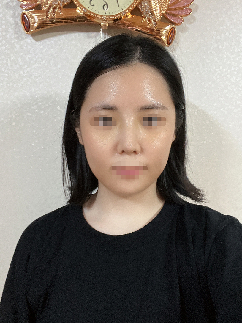 일주일 조금 지났는데 특별하게 통증이 심한것도 없고 불편하거나 일상생활에 지장이 가는건 없어요!