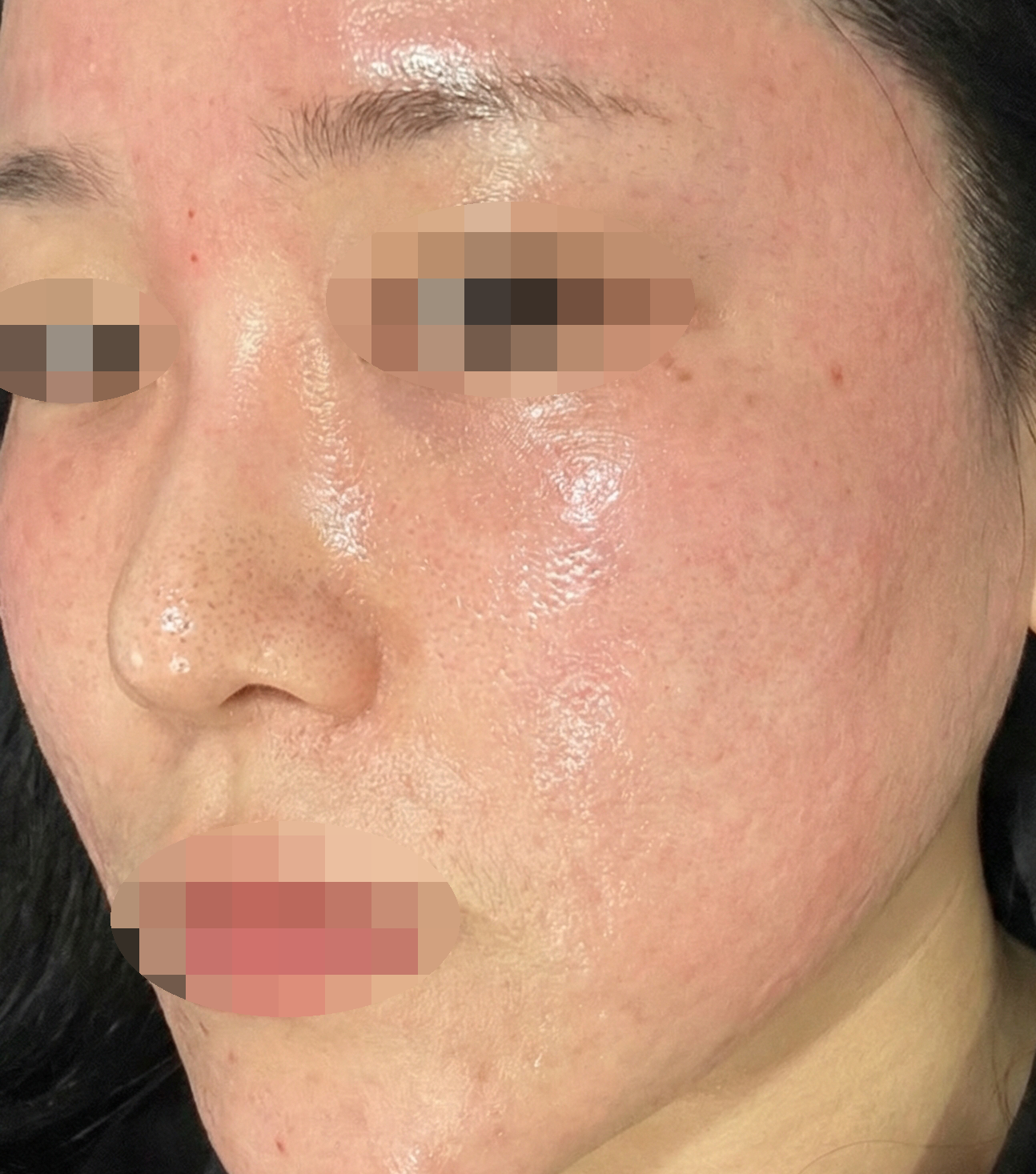 당김 심했는데 리쥬란 받고 촉촉해진 느낌이에요 ㅎㅎ