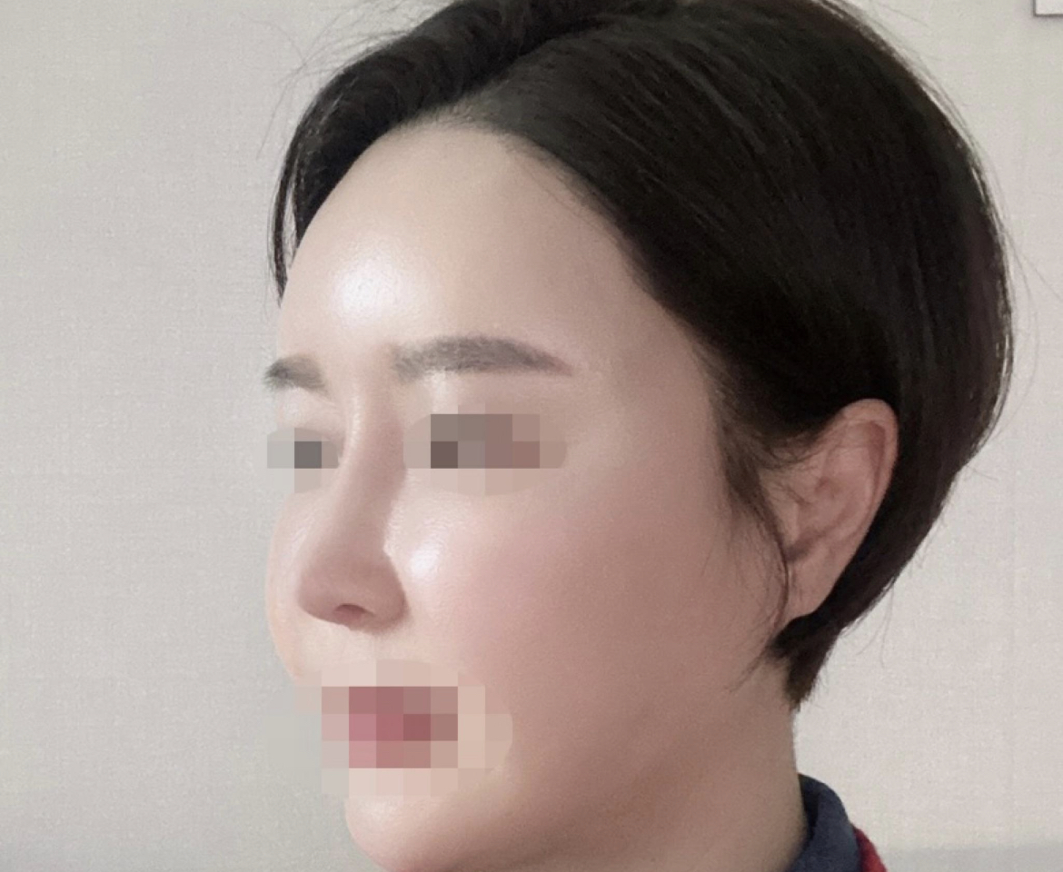 재수술후 3개월 경과입니다.