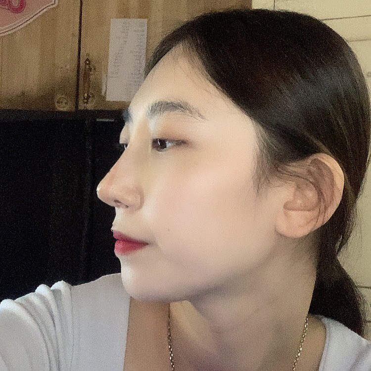 매부리 심했는데 수술하고 많이 좋아졌어요 !
