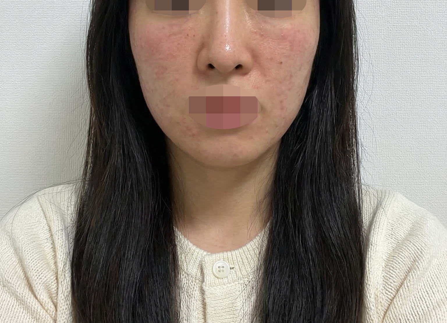건성이라 리쥬란 꾸준히 받는데 가격도 좋고 케어도 확실해서 만족해요 ㅎㅎ