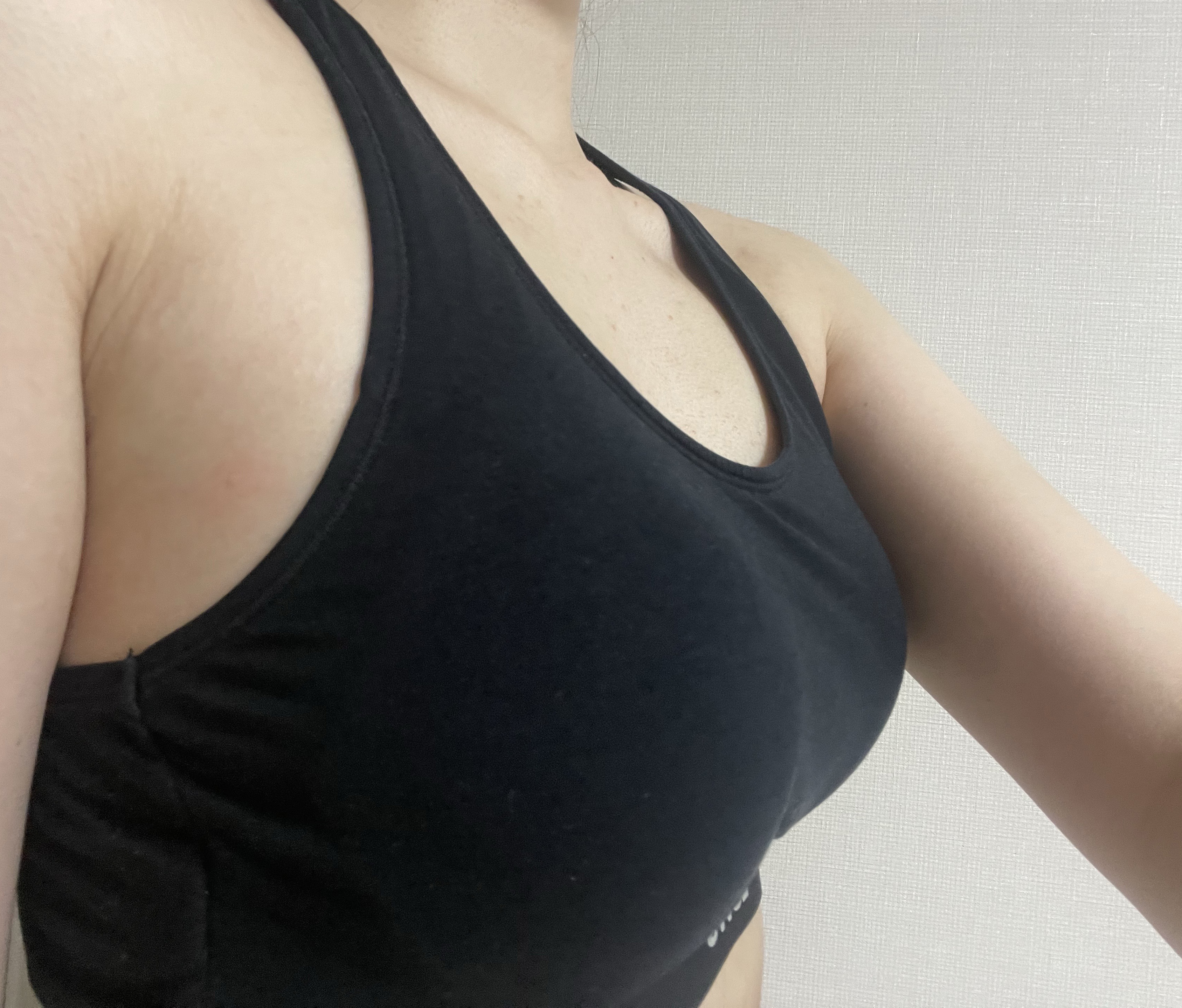 PRP 가슴지이 1달차, 기대 이상으로 만족스러운 변화