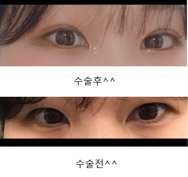 눈매교정 + 자연유착