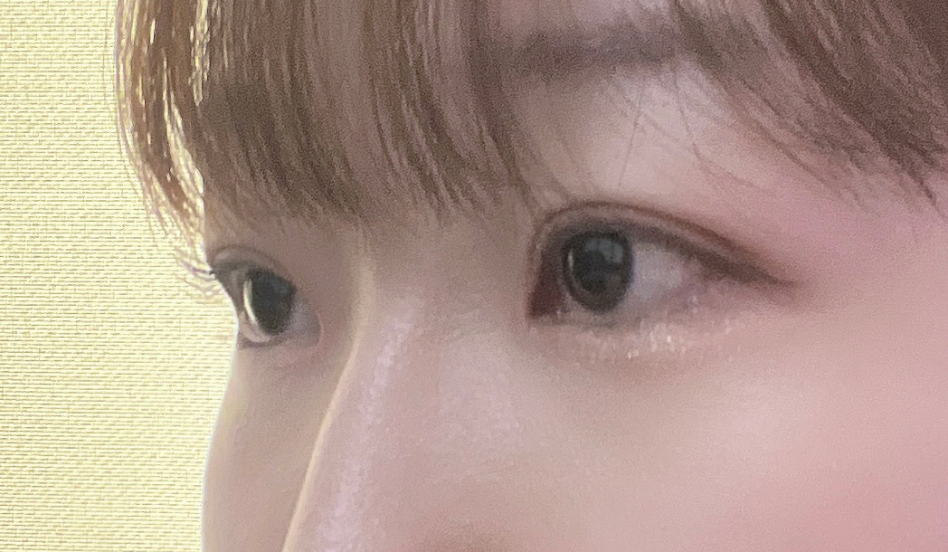 서울아이성형외과에서 자연유착 쌍커풀, 앞트임, 눈매교정 했습니다!!