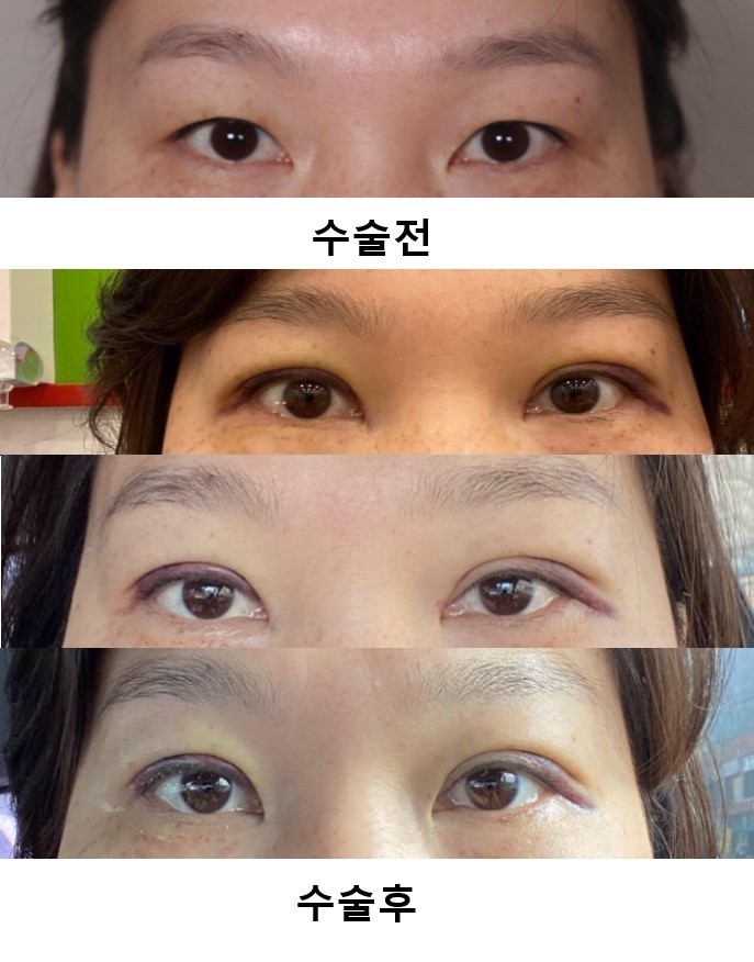 눈매교정 + 쌍꺼풀