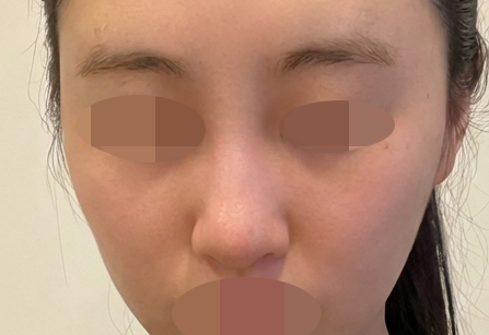 이마라인이랑 주름 고민으로 필러 받았는데 만족이에요 ㅎㅎ