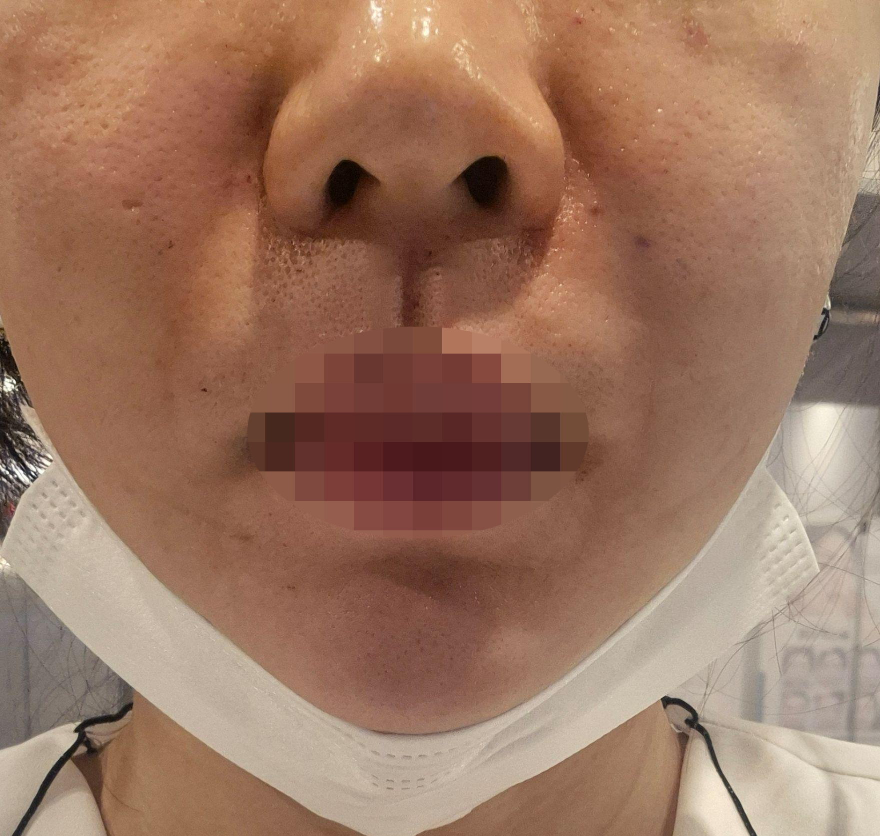 모공 관리 시작하려고 방문했는데 꼼꼼한 시술에 결과까지 기대돼요~