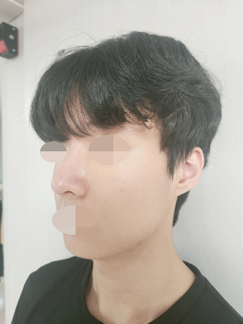코 컴플렉스 해결했어요