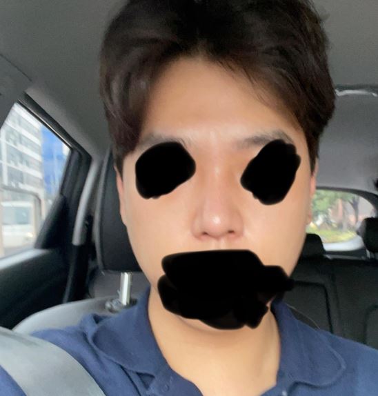 황원장님 코수술 후기입니다