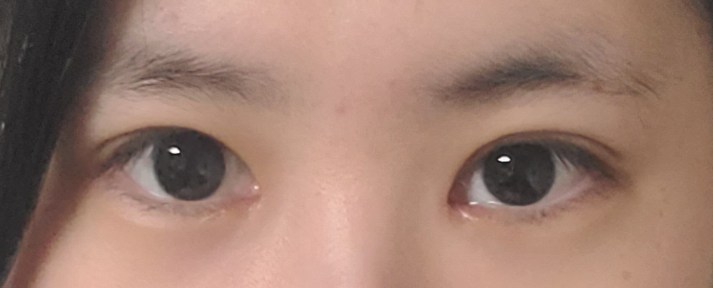 눈수술 2주차, 자연스럽게 자리 잡은 라인 만족