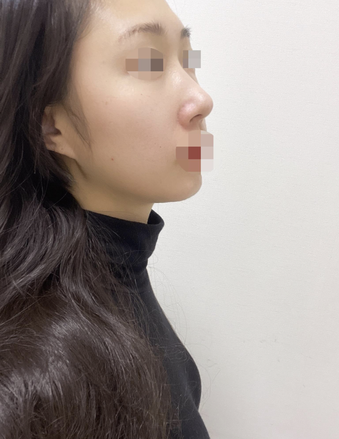 수술한지 세달 된 지금도 아주 만족중입니다 ^^