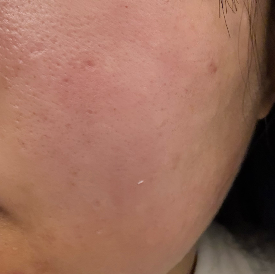 수면으로 여러 시술 한번에 받았는데 대기도 없이 친절해서 좋았어요!