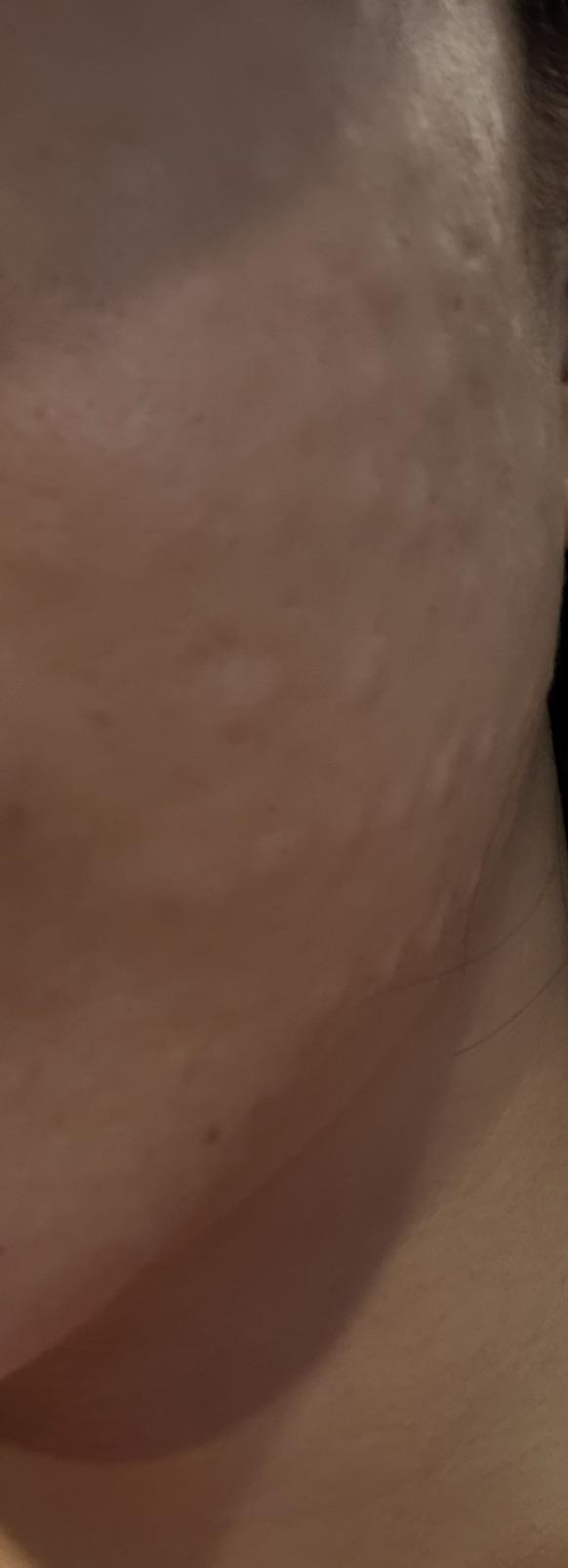 예전에 받아봐서 이번엔 수면으로 편하게 진행했어요~