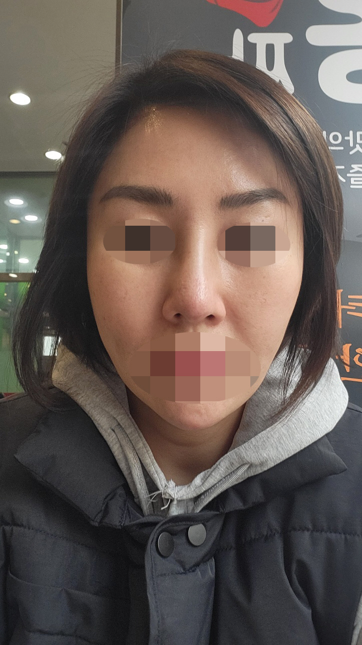 제 얼굴에 맞게 잘 디자인 해주셔서 만족스러워요! 서울아이 코수술 추천요!