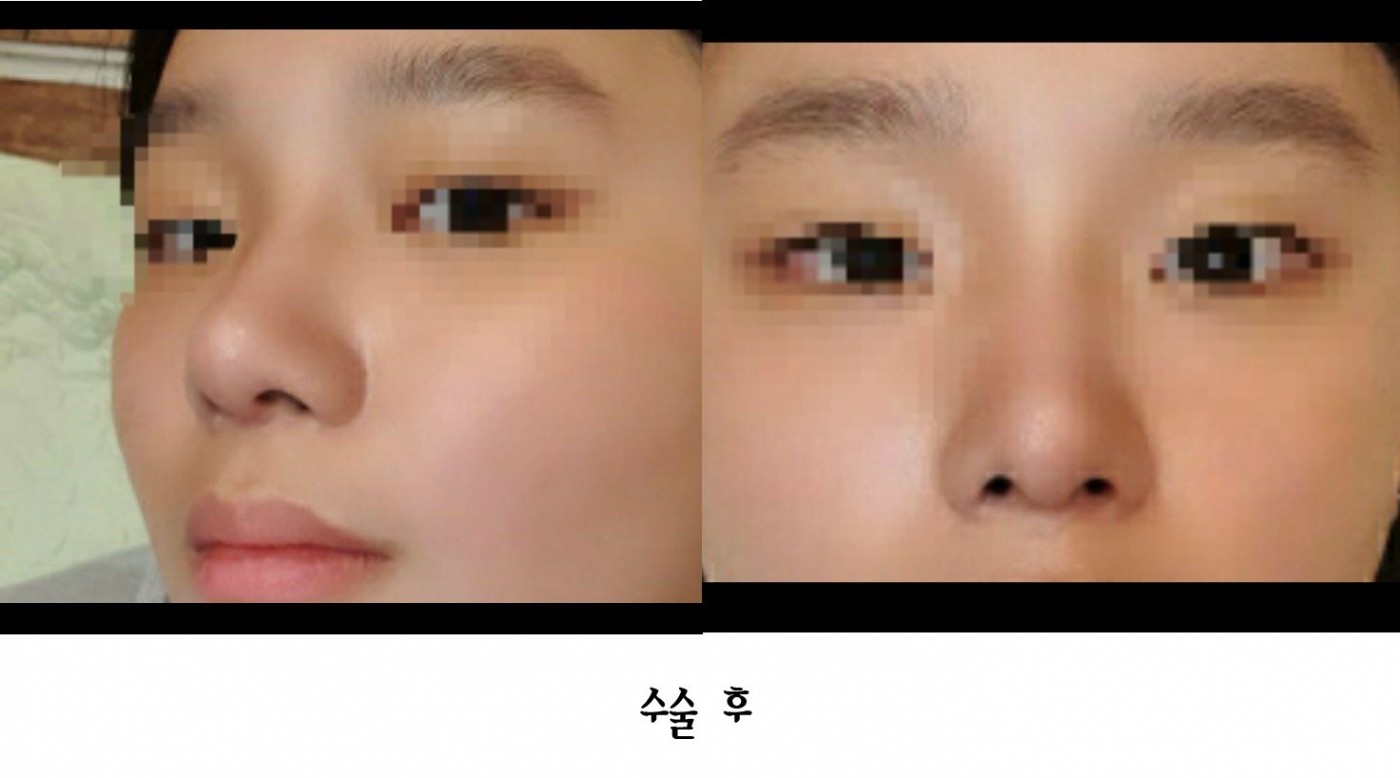 짧은코 들창고 수술