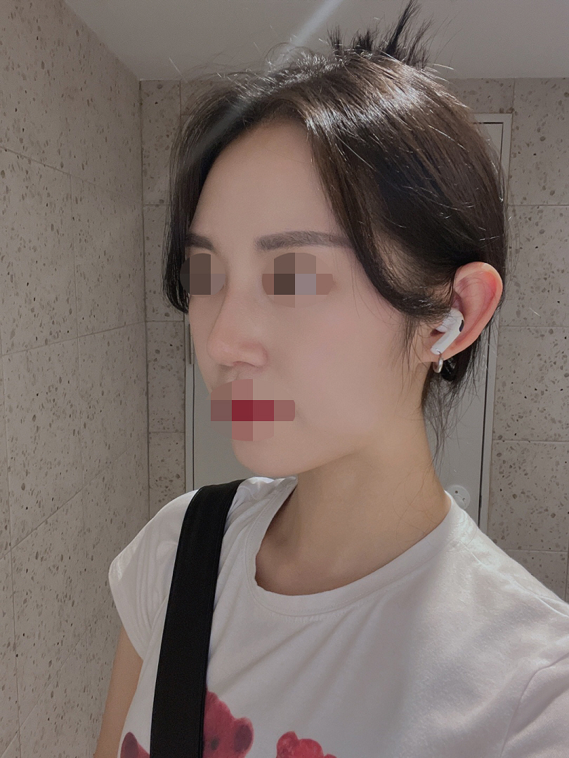 서울아이 성형외과 황원장님 신의손이십니다 ᅮᅮ 완전 추천드려요