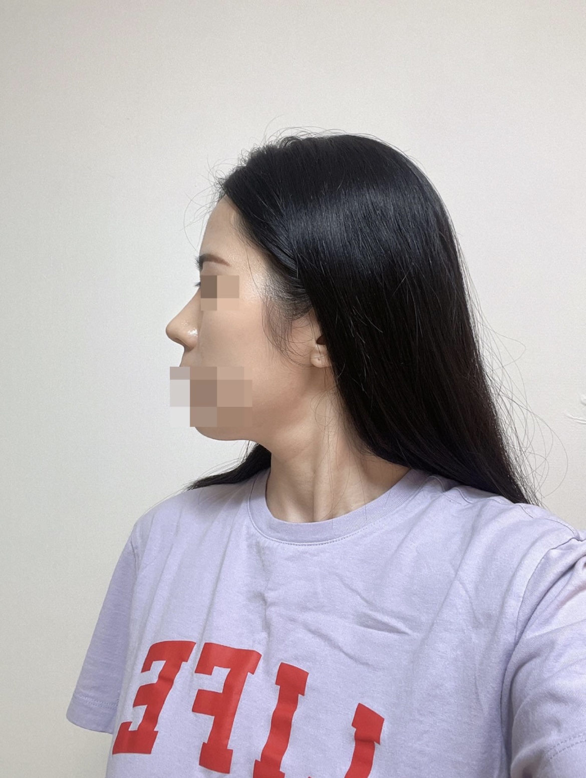 서울아이성형외과 ,,,증말 최고에요 !