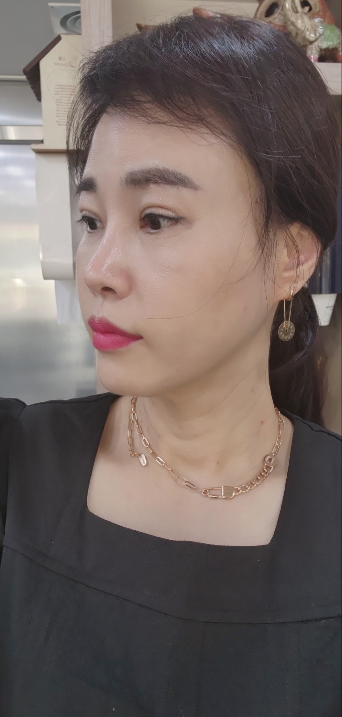 잘해주셔서 일단 붓기는 시간이 지나봐야 할거같네요^^~~