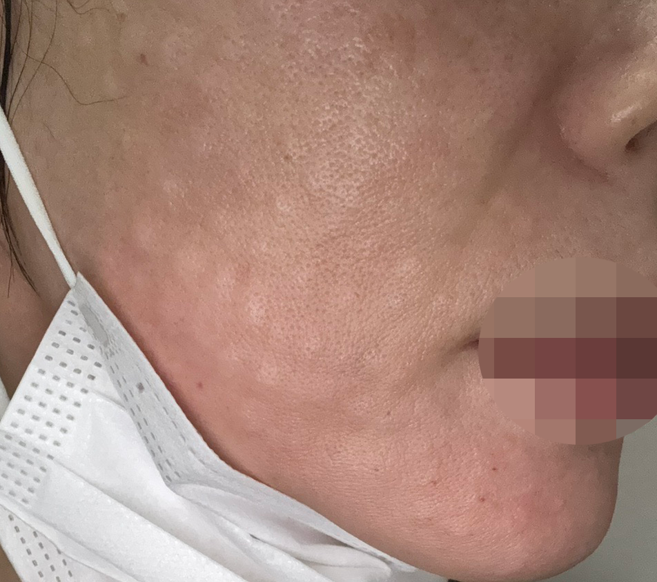 개인 맞춤으로 꼼꼼하게 해주는 리쥬란, 계속 다닐 것 같아요~