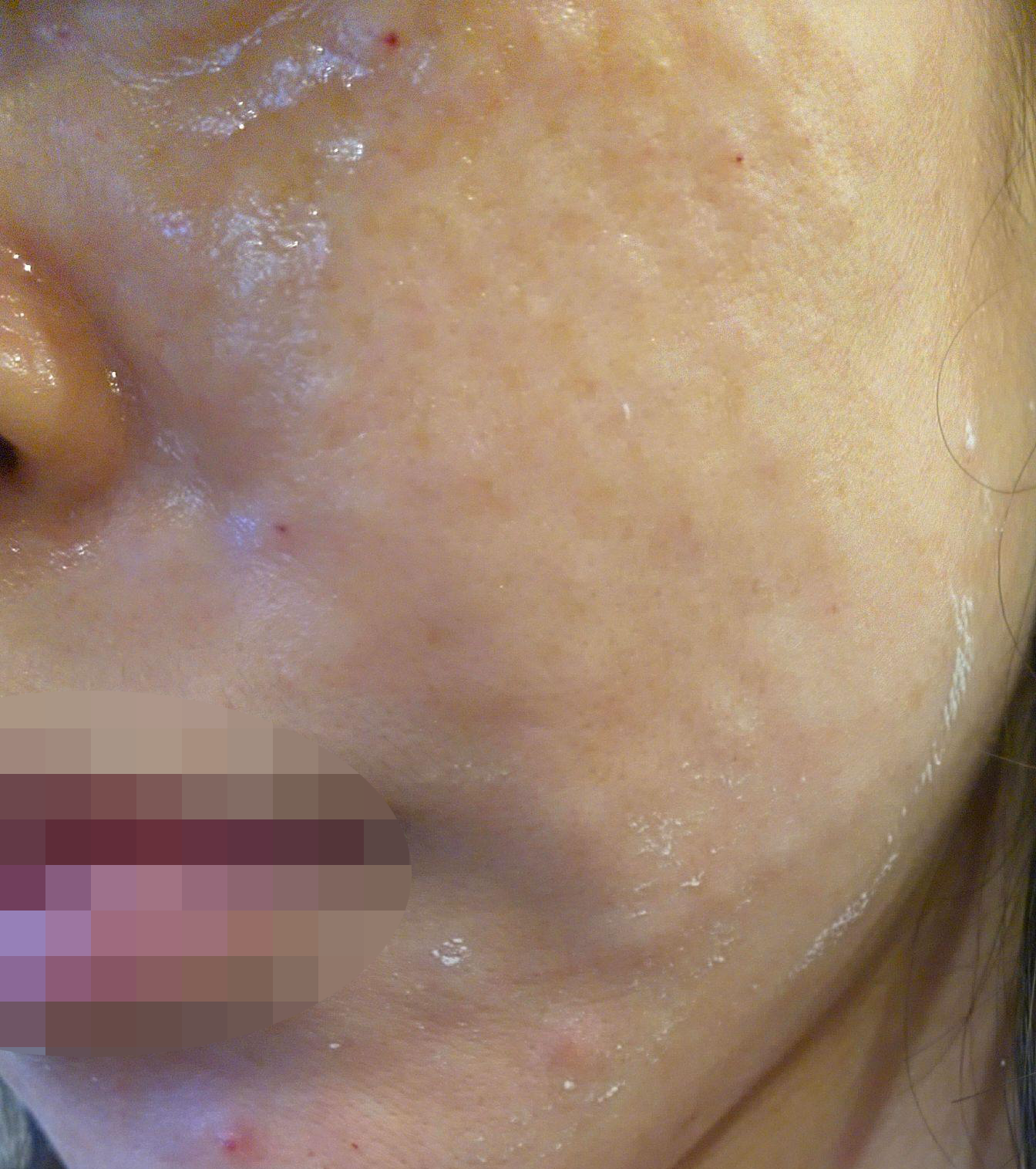 수면마취로 받으니 아픈지도 모르고 끝나서 너무 편했어요!!