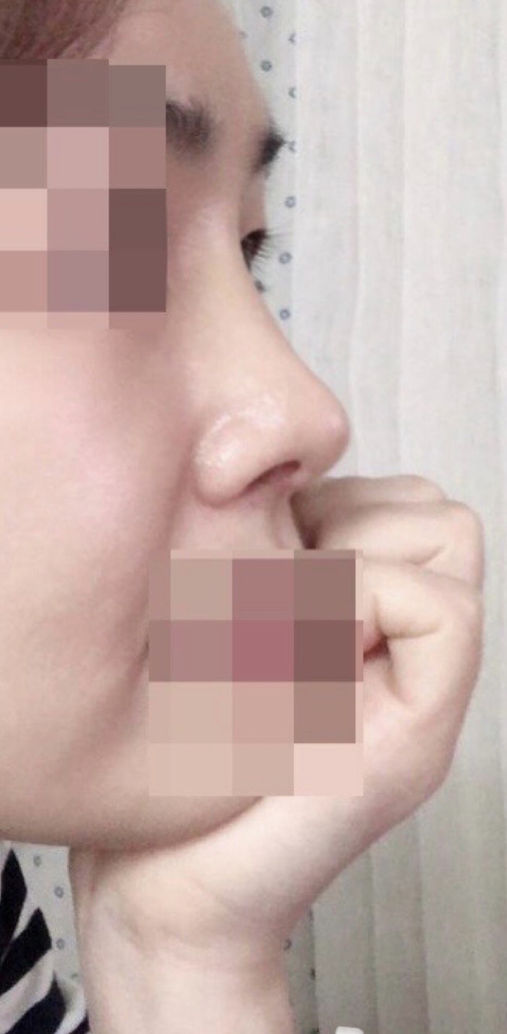 수술 후 2주 지났네요