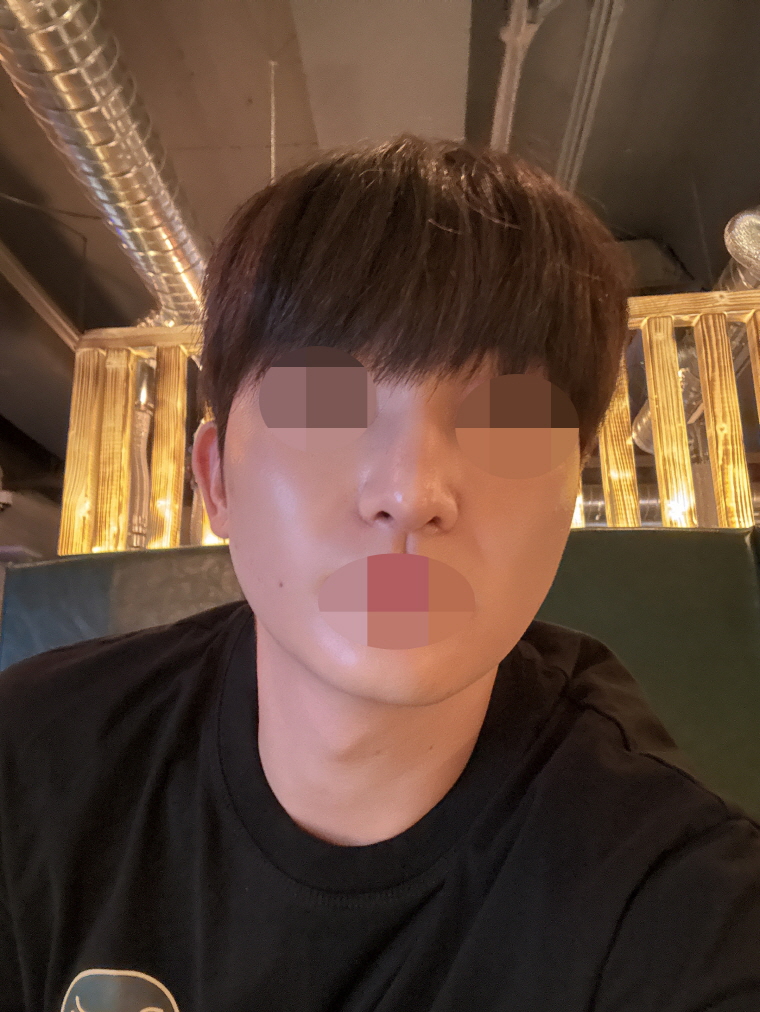매부리코 교정 잘됐고 다들 친절하게 응대해 주셔서 너무 좋았습니다!