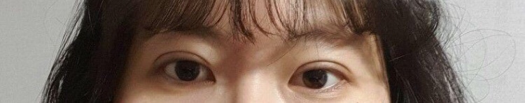 눈매교정 / 자연유착 = 눈재수술