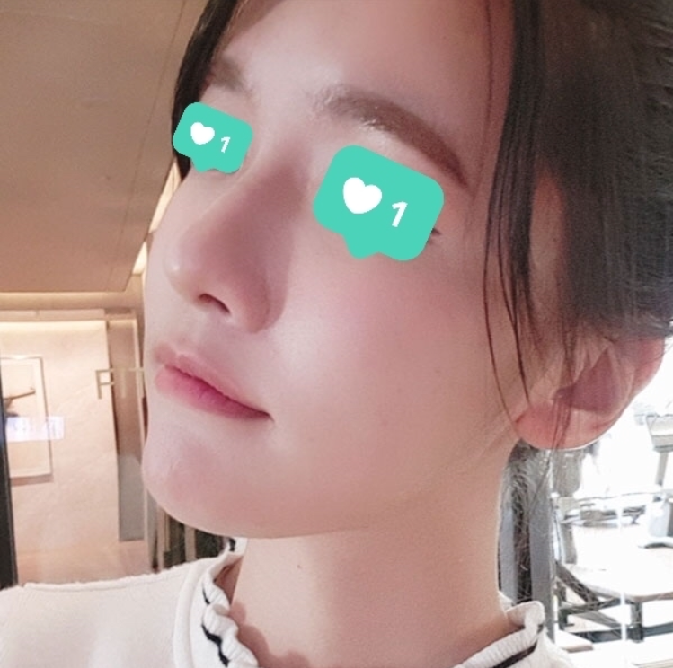 복코 성형 후기가 왔습니다 (1년차)