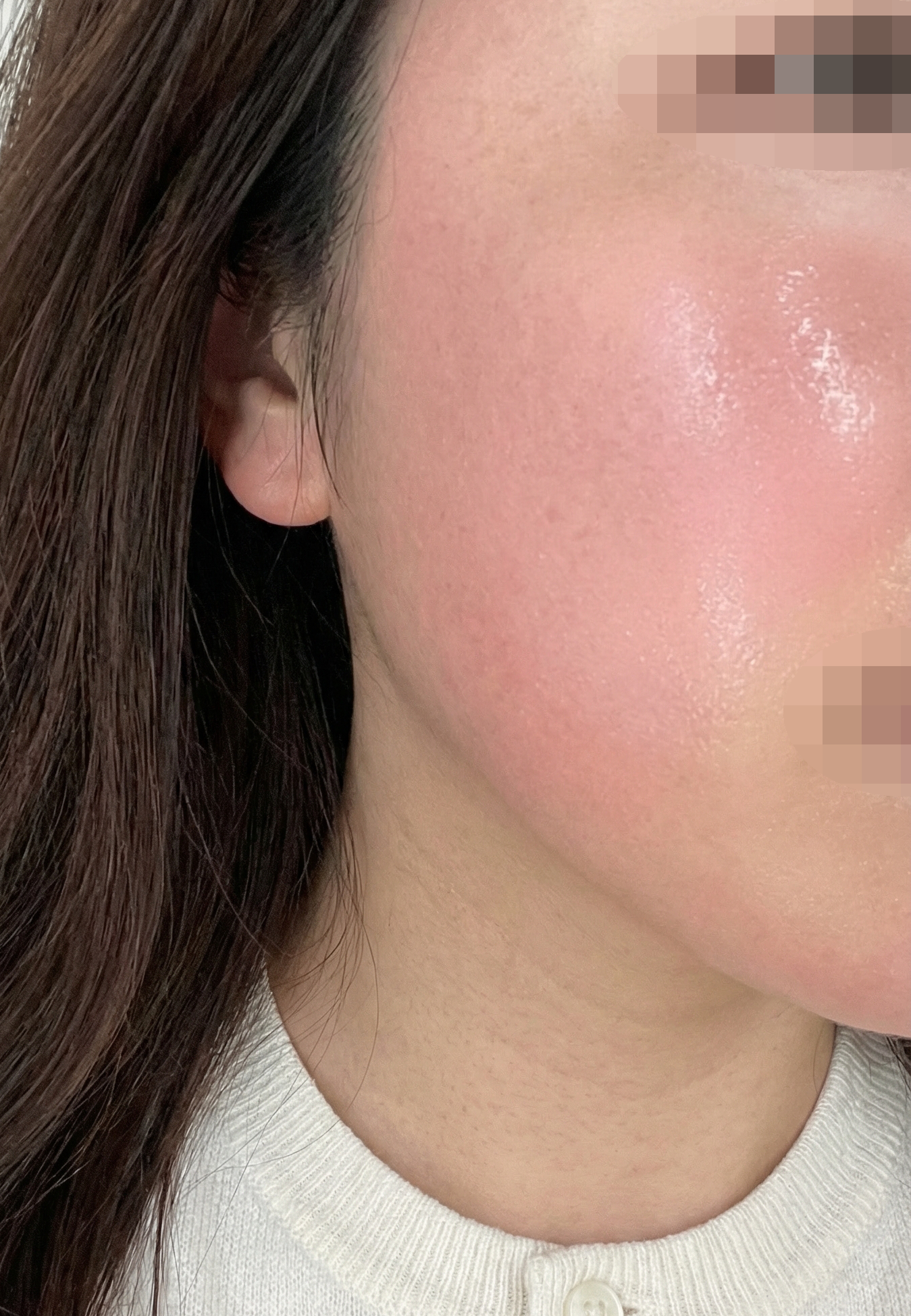 심부볼 고민으로 온다리프팅 받았는데 빠르고 좋은 것 같아요 ㅎㅎ
