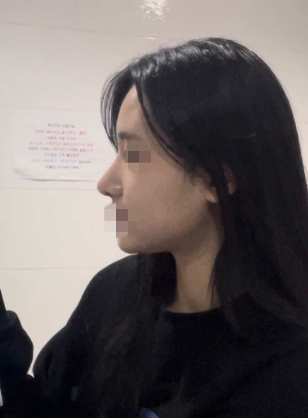 서울아이성형외과 황정일 원장님께 수술받은지 3개월 됐어요!