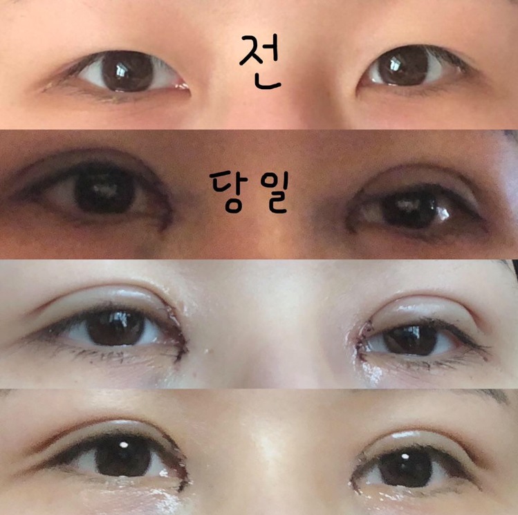 쌍수 윗트임 후기